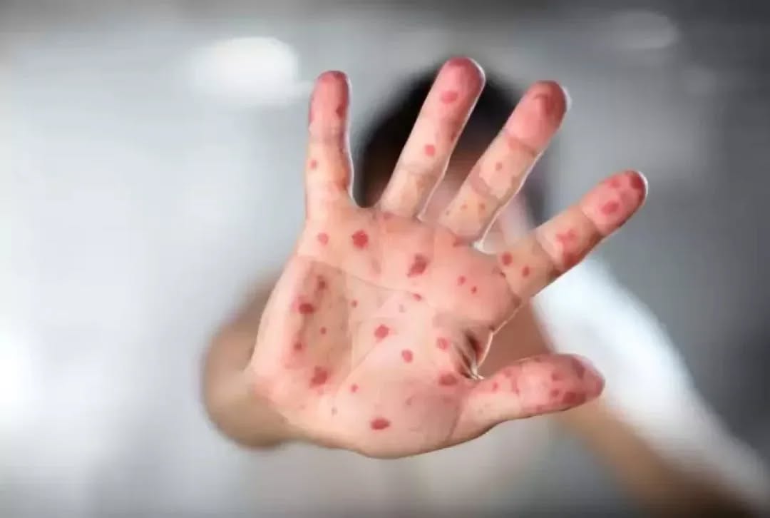 Қызылша – қауіпті жұқпалы ауру!