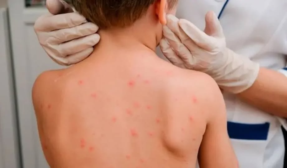 Корь – это острое вирусное инфекционное заболевание