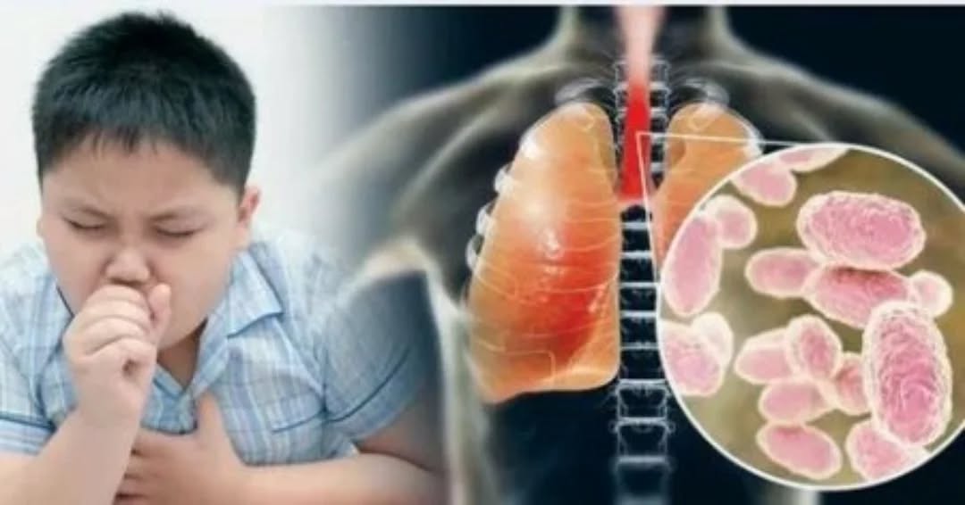 Көкжөтелге қарсы вакцинация баланы қалай қорғайды?