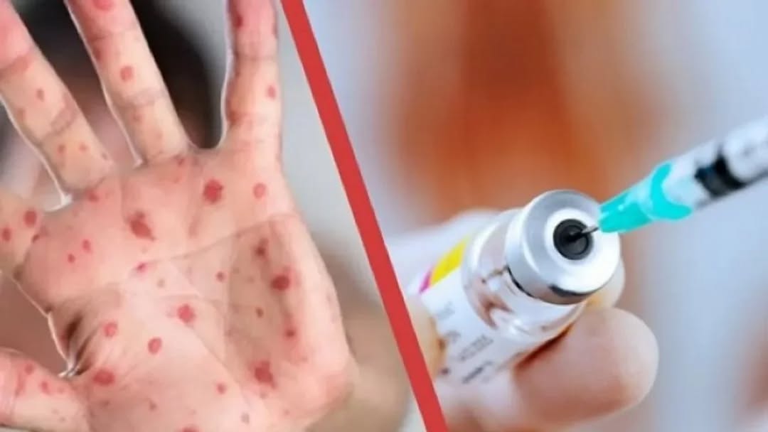 Қызылша (корь) — өте жұқпалы вирустық ауру