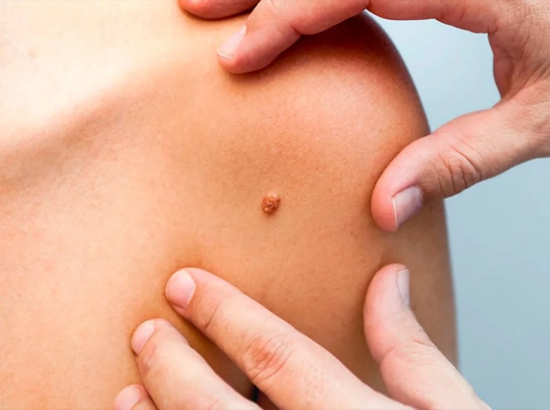 ВПЧ (вирус папилломы человека): что важно знать