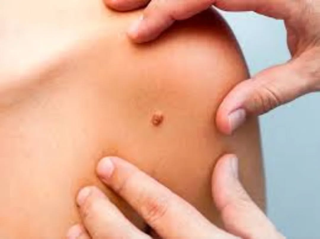 Адам папиллома вирусы (АПВ) деген не?