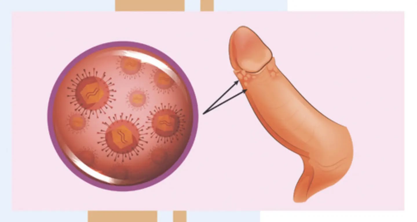 Адам папиллома вирусы (АПВ) – өте кең таралған вирустық инфекция