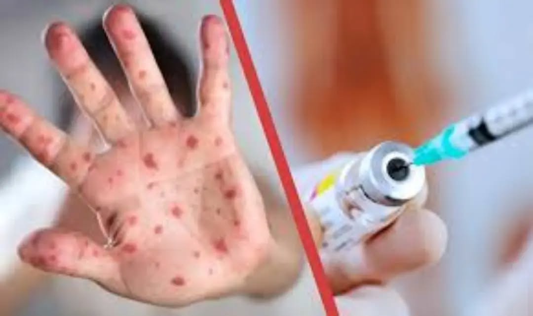 Корь – опасное инфекционное заболевание