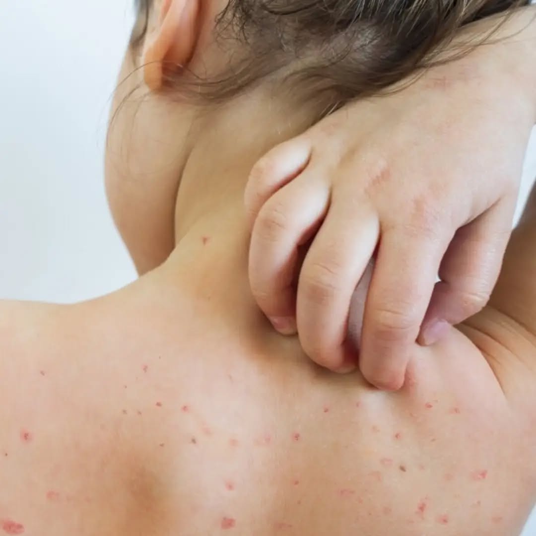 Корь – это вирусная инфекция