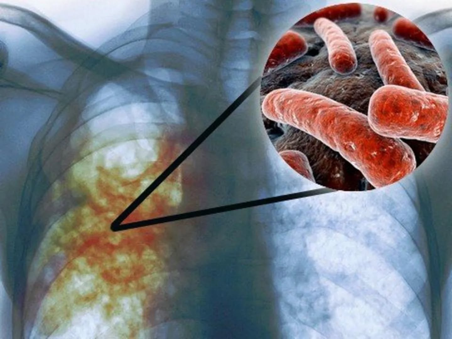 24 наурыз — Дүниежүзілік туберкулезге қарсы күрес күні